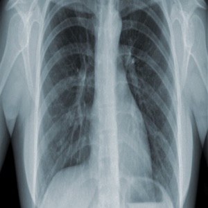 Patient Support and TB Treatment Adherence