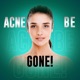 Acne Be Gone Podcast
