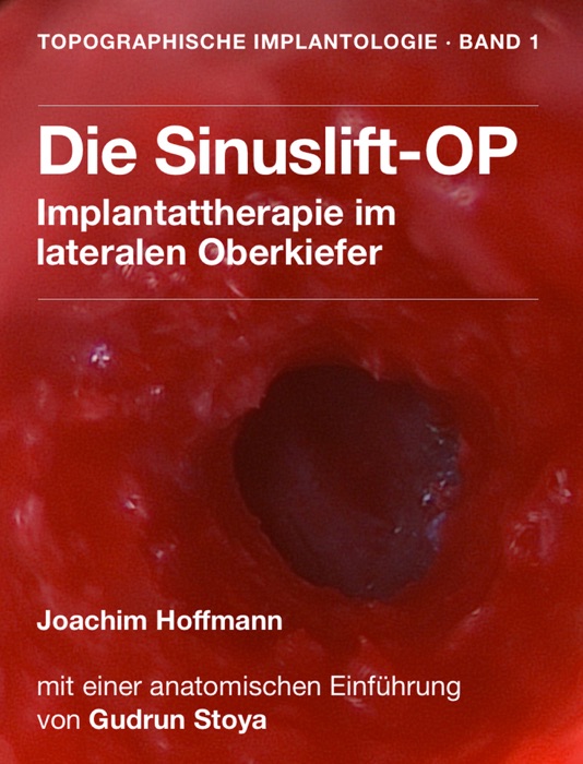 Die Sinuslift-OP