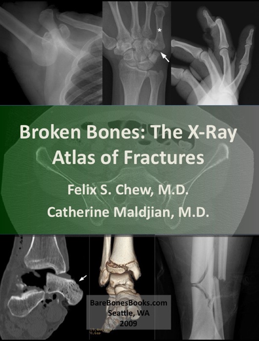 Broken Bones