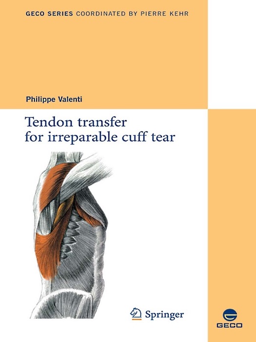 Tendon transfer for irreparable cuff tear