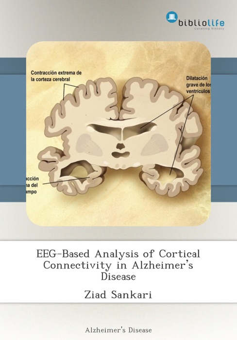 EEG-Based Analysis of Cortical Connectivity in Alzheimer’s Disease