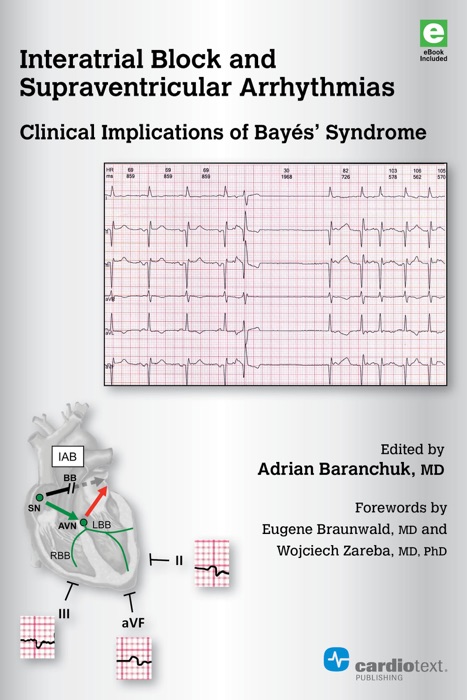 Interatrial Block and Supraventricular Arrhythmias: Clinical Implications of Bayés’ Syndrome