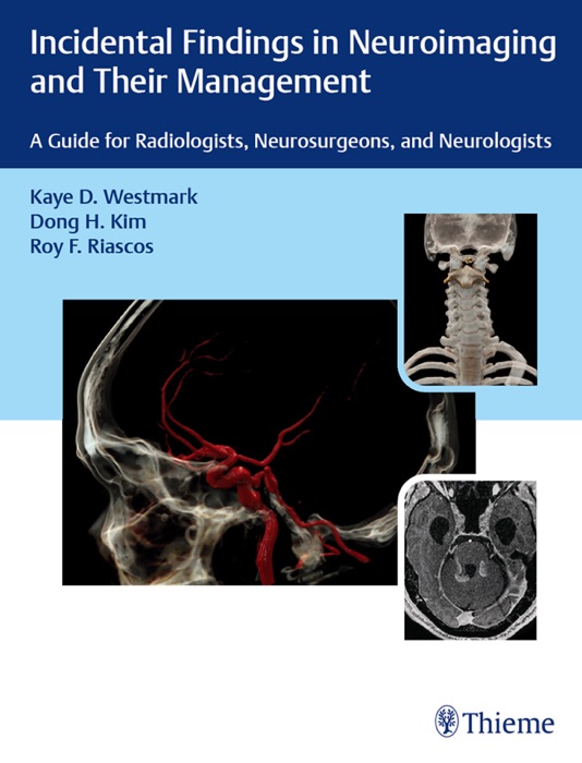 Incidental Findings in Neuroimaging and Their Management