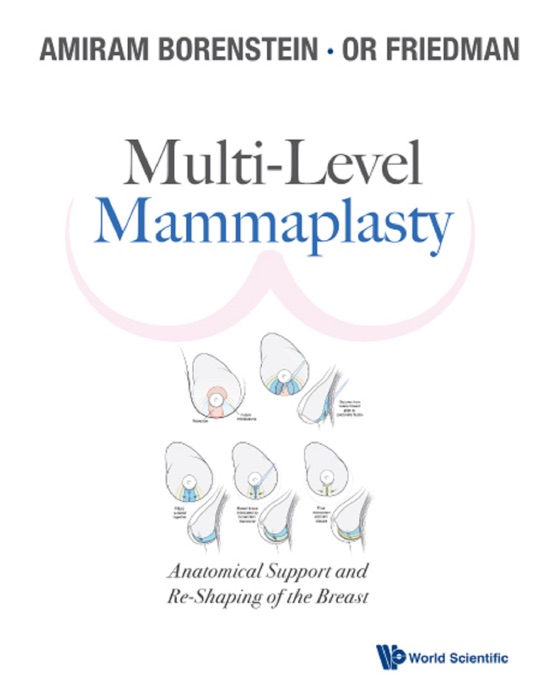 Multi-Level Mammaplasty