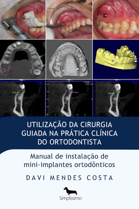 Utilização da cirurgia guiada na prática clínica do ortodontista