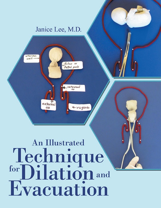 An Illustrated Technique for Dilation and Evacuation