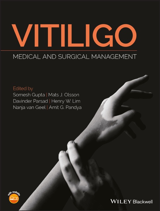 Vitiligo