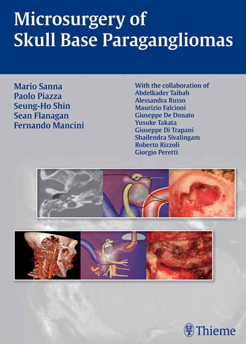 Head and Neck Paragangliomas