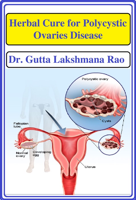 Herbal Cure for Poylcystic Ovaries Disease