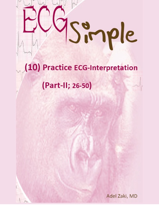 ECG Simple (10) Practice ECG-Interpretation (Part-II)