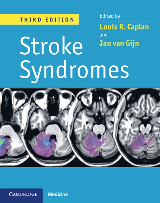 Stroke Syndromes: Third Edition