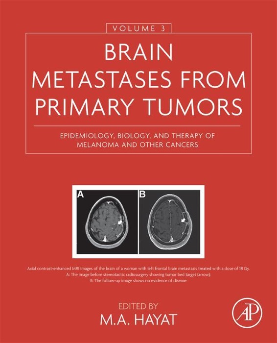 Brain Metastases from Primary Tumors, Volume 3