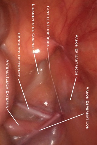 Hernia Inguinal -- Cirugía Laparoscópica de la Hernia Inguinal Lite