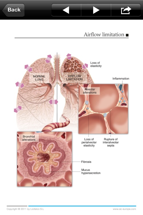 Miniatlas COPD