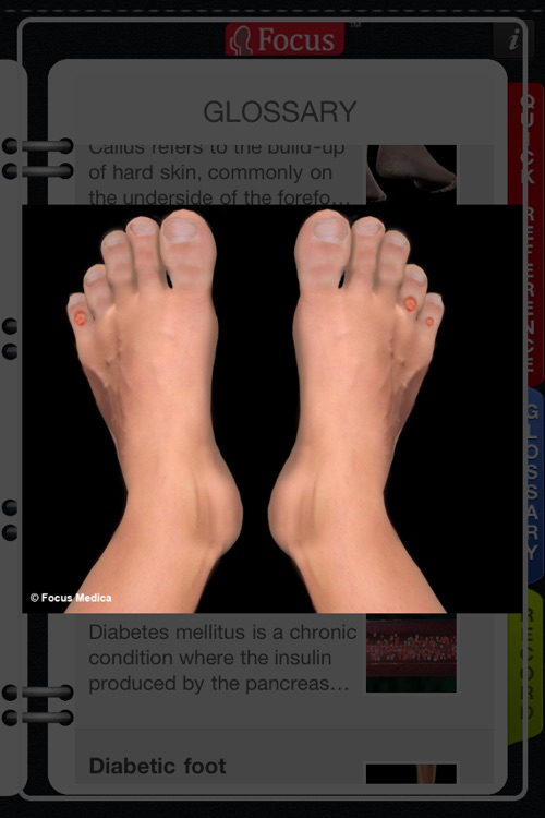 Animated Quick Reference Guide -  DiabeticFoot