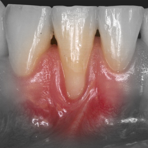 iMuco Gingival recessions