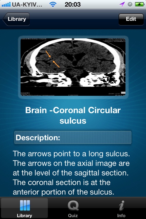CT Scan