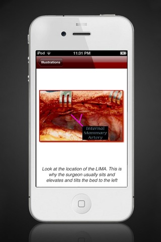 CABG For Anesthesia screenshot 3