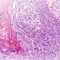 Cancer staging plays a pivotal role in the battle on cancer