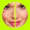 Pimple Remover