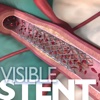Visible Stent