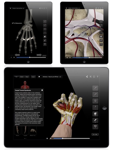 Hand & Wrist Pro III for iPad screenshot 2