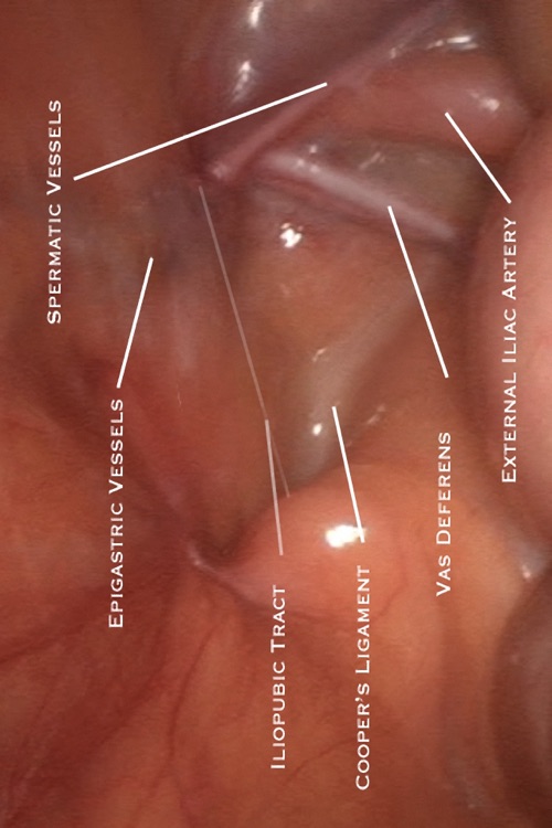 Laparoscopic Inguinal Hernia Repair