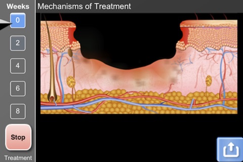 Understanding Hyperbaric Oxygen Therapy-Lite screenshot 3