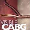 Visible CABG