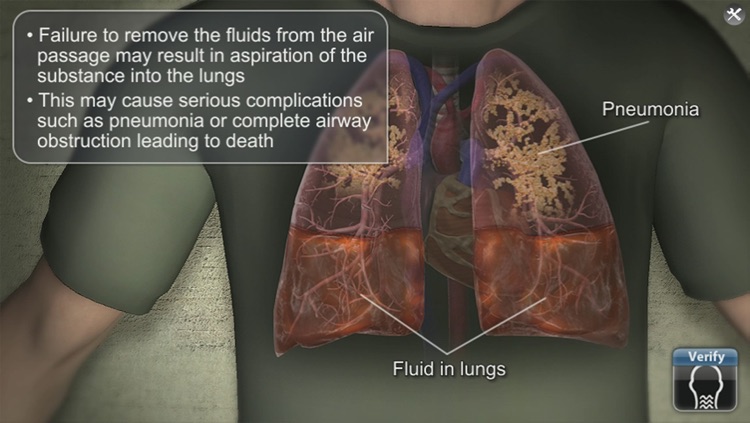 Medrills: Suctioning Airway