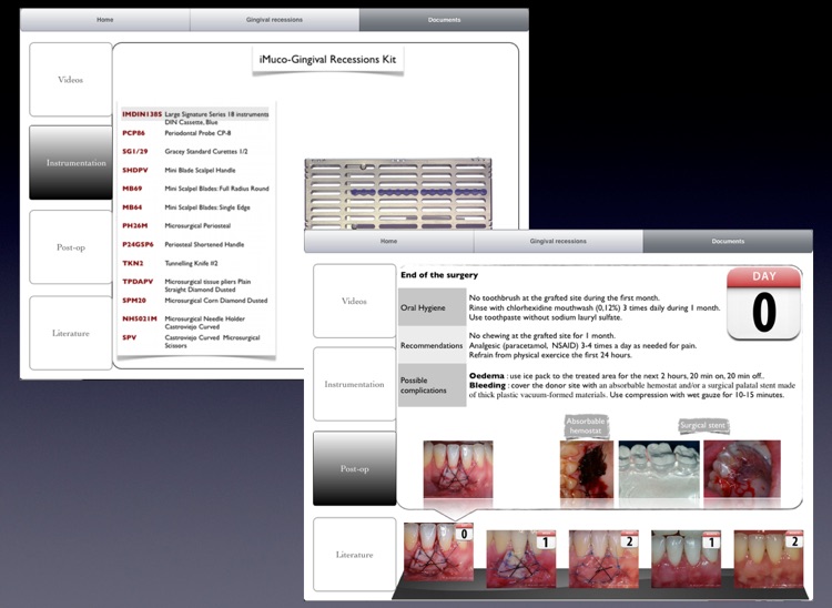iMuco Gingival recessions screenshot-4
