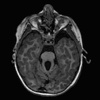 Congenital Central Nervous System Malformations