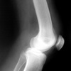 Aché - Ortopedia e trauma do esporte: joelho