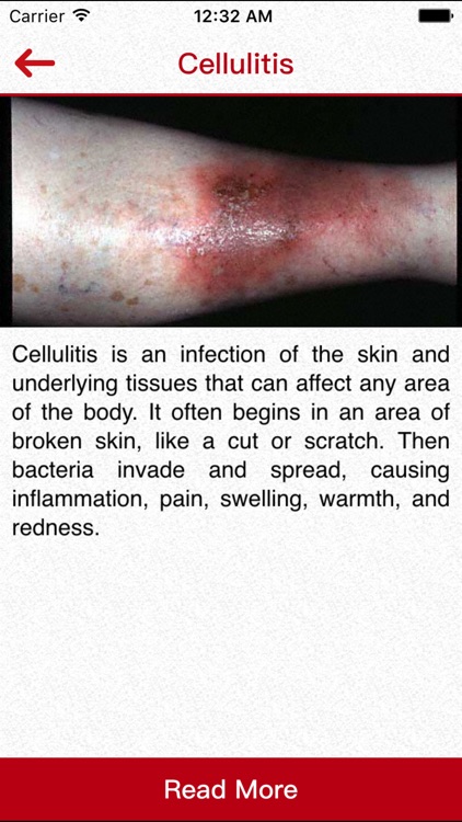 Infections