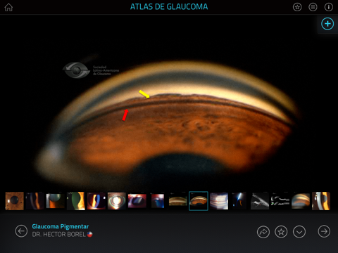 Atlas de Glaucoma screenshot 3