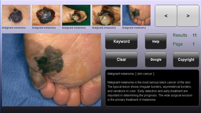 YSP Dermatology Image Database for iPhon