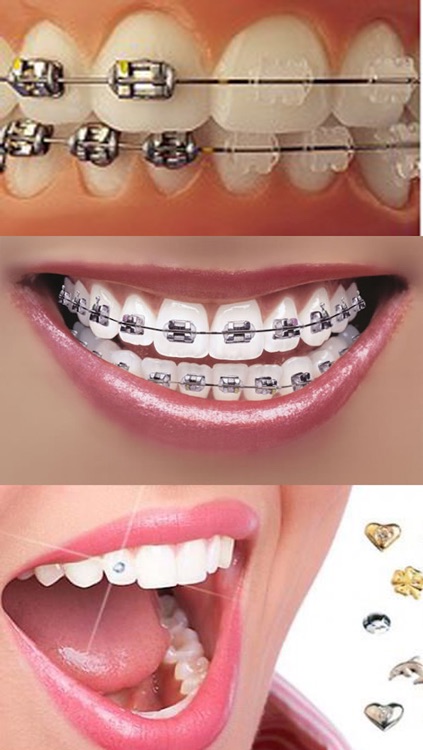 Orthodontic تقويم الاسنان