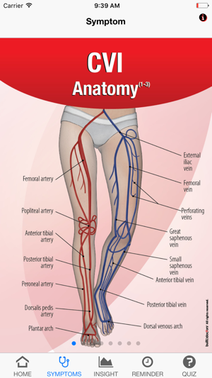 Signs & Symptoms Chronic Venous Insufficiency(圖2)-速報App