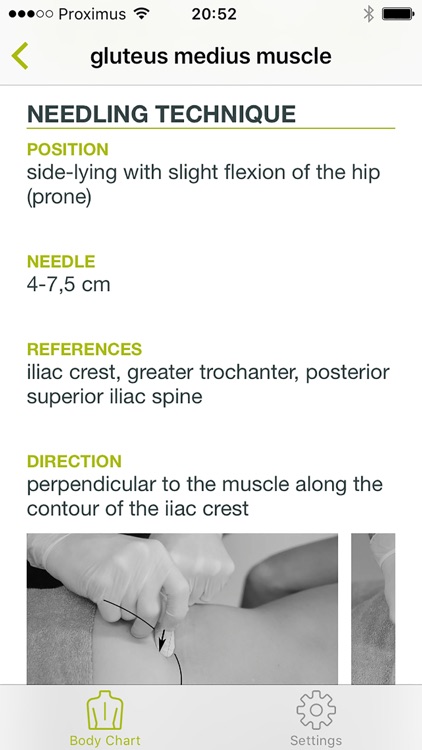 Dry Needling Charts