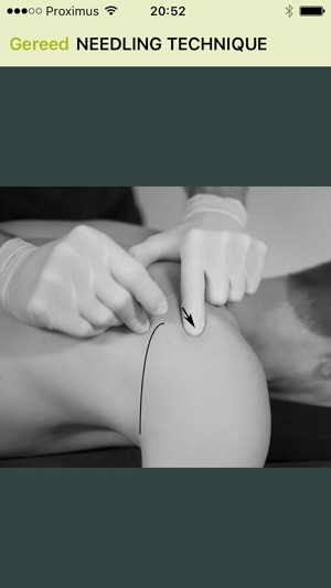 Dry Needling Guide(圖4)-速報App