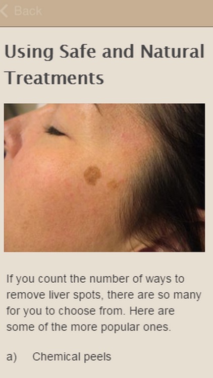 How To Remove Liver Spots