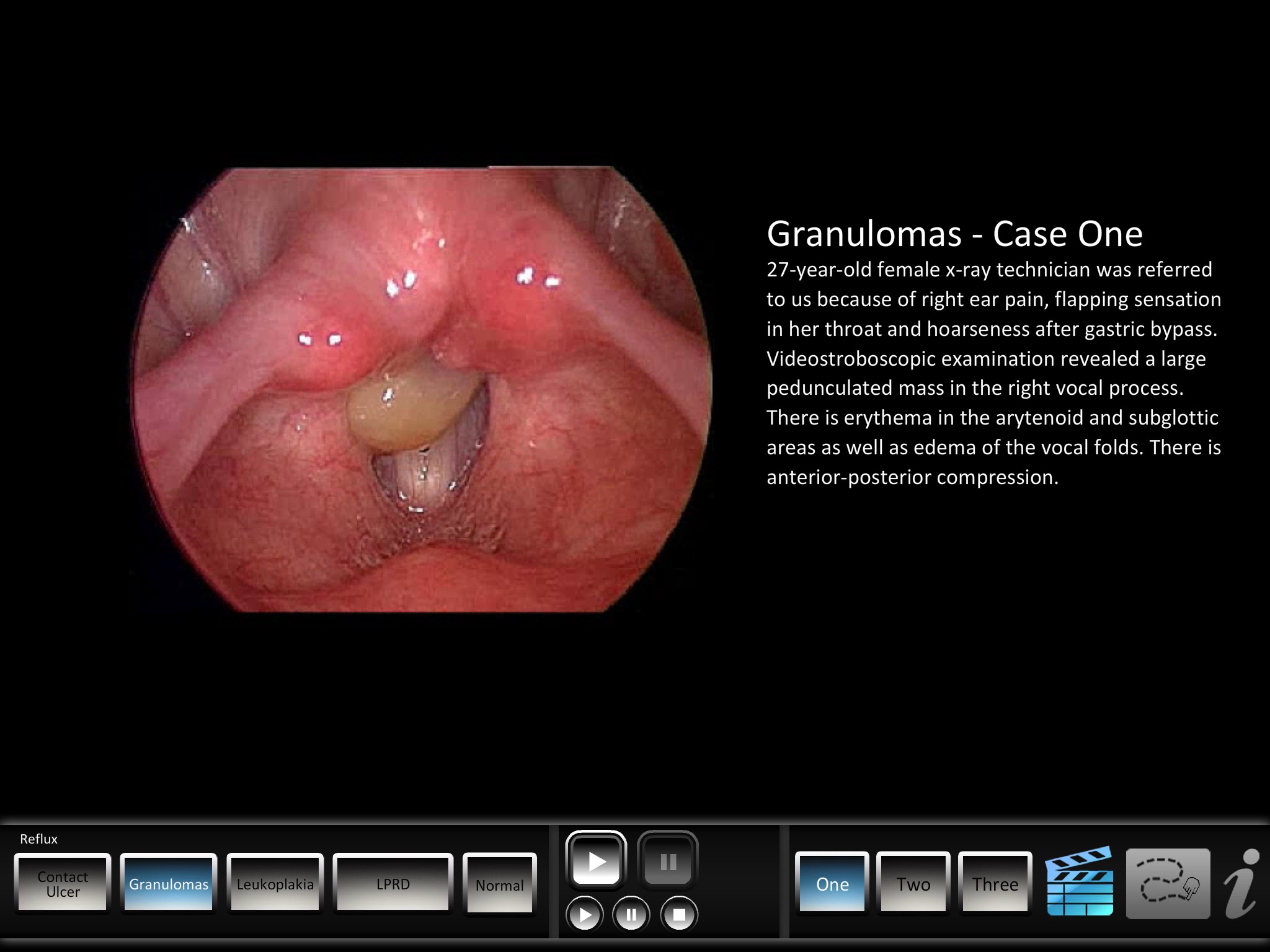 Vocal Pathology: Reflux screenshot 4