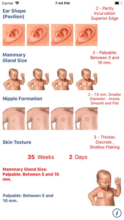 Neonatology: Test Capurro