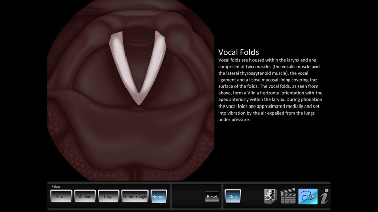 Vocal Pathology: Polyps screenshot-3