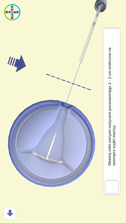IUS Insertion screenshot-4