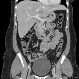 CT Abdomen Pelvis