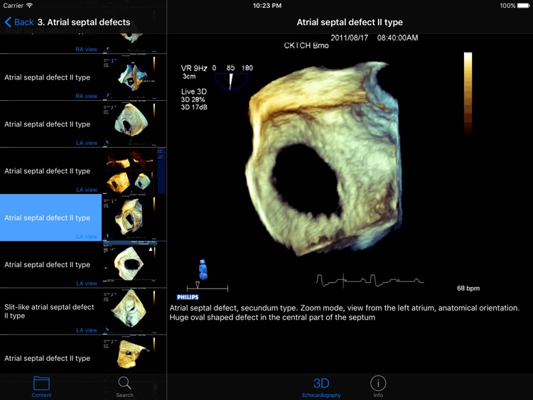 CARDIO3®3D Echocardiography HD screenshot-4