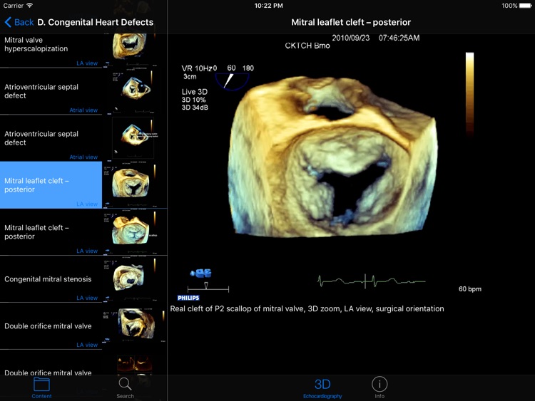 CARDIO3®3D Echocardiography HD screenshot-3