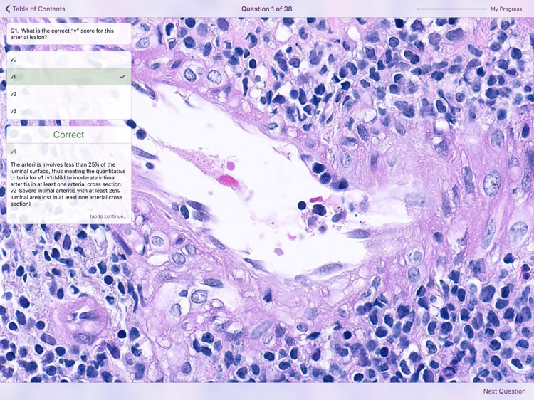 Renal Transplant Pathology screenshot-7